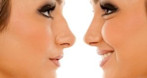 Quels sont les risques de la rhinoplastie ? intervention-esthetique-nez